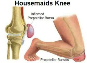 causes knee bursitis