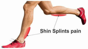 What Is Shin Splints?