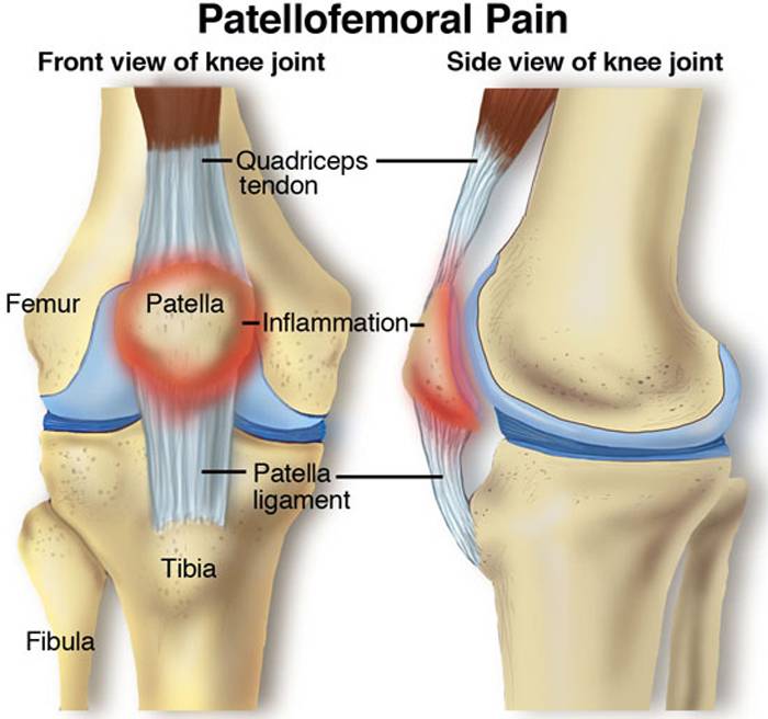 Patellofemoral Pain PFP: Causes, Symptoms, and Treatment
