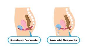 What Is Pelvic Floor Pain?