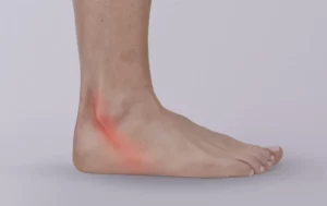 Peroneal Tendonitis: Causes, Symptoms, and Treatment