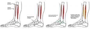 Medial Tibial Stress Syndrome: Causes, Symptoms, and Treatment