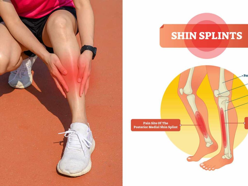Shin Splints Meaning Treatment And Prevention Tips Shin Splints Meaning Treatment And Prevention Tips