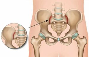 What is SIJ Dysfunction and How Can You Treat It?