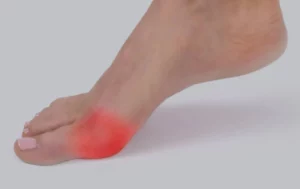 What Is Turf Toe?