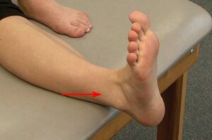 What Is Sprained Ankle?