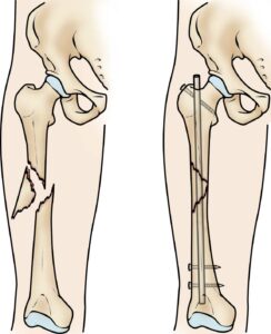 What is a a femur fracture