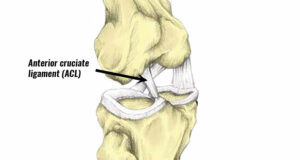 The Ultimate Guide to Recognizing and Treating an ACL Sprain