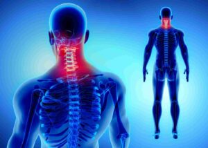 What Activities Should Be Avoided With Cervical Radiculopathy?