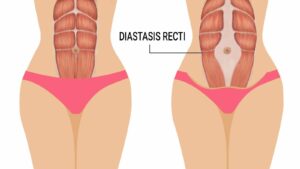 Diastasis Recti for women