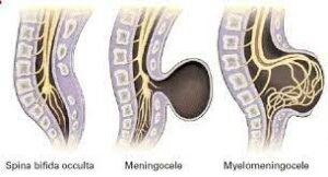 What Is Spina Bifida?
