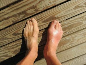 Cuboid Syndrome