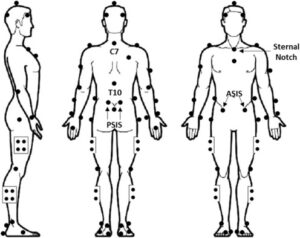 transtibial amputation