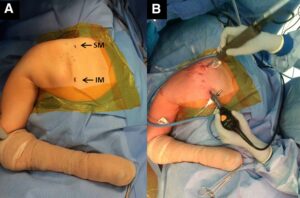 What You Need to Know About Snapping Scapula Syndrome