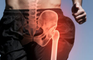 Can Hip Impingement Be Prevented?