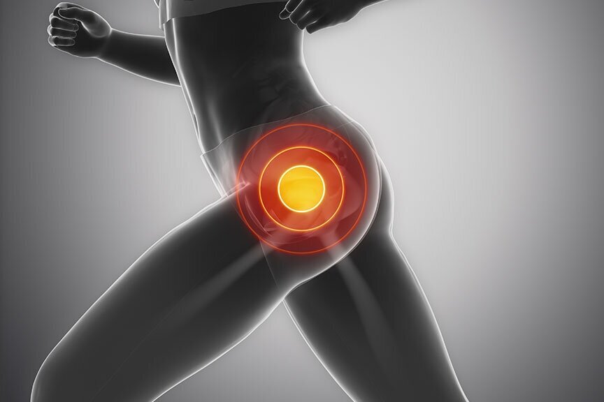 What is Hip Impingement and How Can You Treat It?