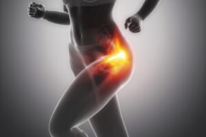 Trochanteric Bursitis: How Can You Treat This