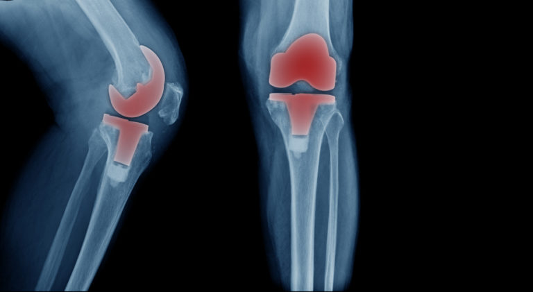 Total Knee Replacement: Everything You Need to Know