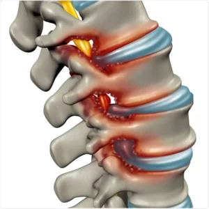 What Is Spinal Stenosis?