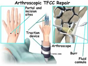 The Best TFCC Tear Treatment Protocol