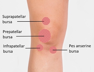 Knee Bursitis Recovery Time | Ways To Recover Knee Bursitis