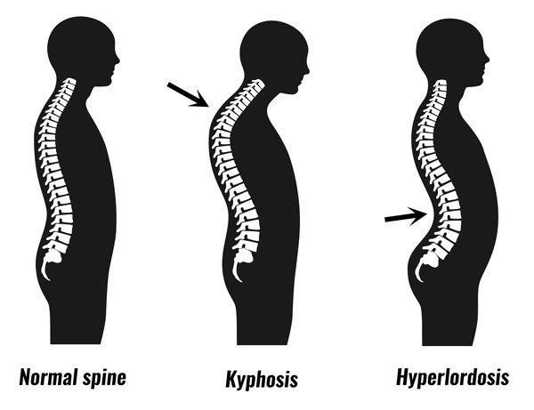 What Is Hyperkyphosis and What Are the Causes?