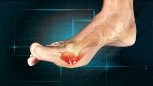 Can Turf Toe Be Prevented?