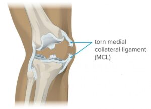 Causes Of Medial Collateral Ligament (MCL) Pain