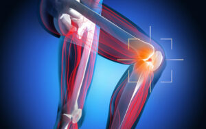 What Is MPFL (Medial Patellofemoral Ligament)?