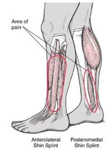 What Is Medial Tibial Stress Syndrome?