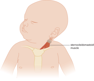 What Is Torticollis?