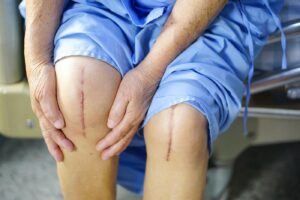 How Painful Is Total Knee Replacement?