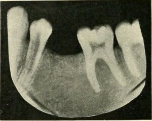 What is Trismus and How Can You Treat It?
