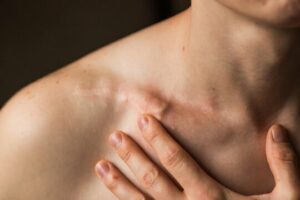 Treatments For Clavicle Pain