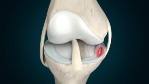 What Is Meniscal Tear?