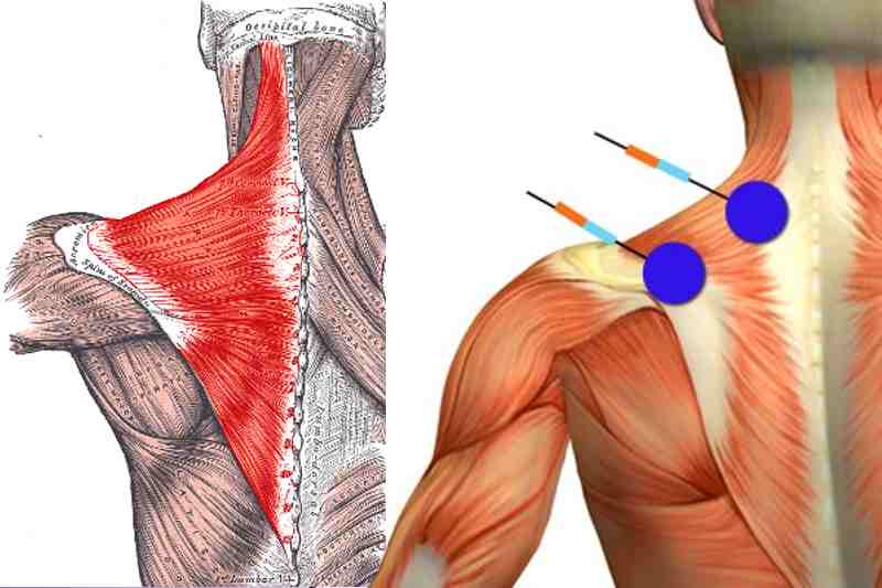 Trapezius Massage: A Quick and Powerful Way to Relieve Neck Pain