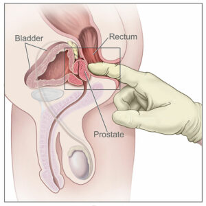 What Is Prostate Discomfort?