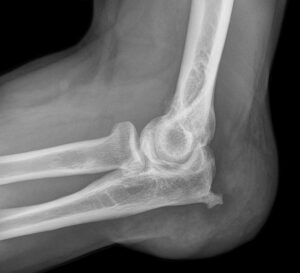 Causes of Bursitis Elbow