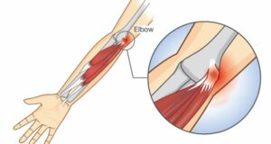 How To Prepare for Physical Therapy For Pitcher's Elbow?