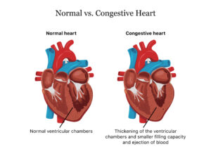 Physical Therapy: A Top Treatment for Congestive Heart Failure