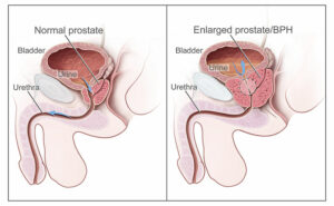 Prostate Discomfort When Sitting – Why it Happens and How Can You Manage