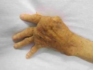 What Is Rheumatoid Arthritis?