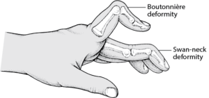 Symptoms of Swan Neck Deformity of the Finger