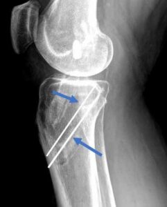 Treatment Guide For Torn PCL To Run Again