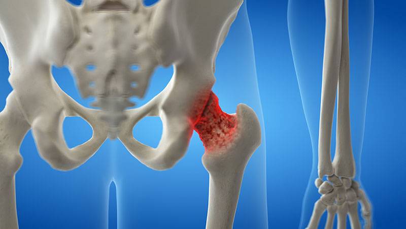 Types of Physical Therapy Guide For Osteopenia