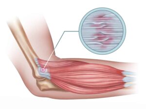 Understanding Internal Scar Tissue