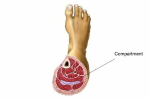 What Is Compartment Syndrome?