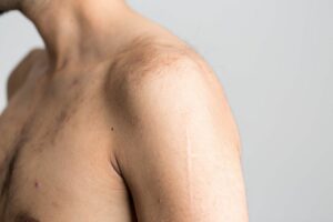 What Is Dislocated Shoulder?