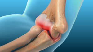 What Is Elbow Pain?