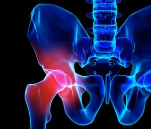 What Is Hip Pain?